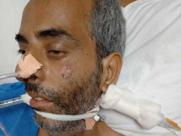 Please Help My Uncle Recover From Brain Tumours