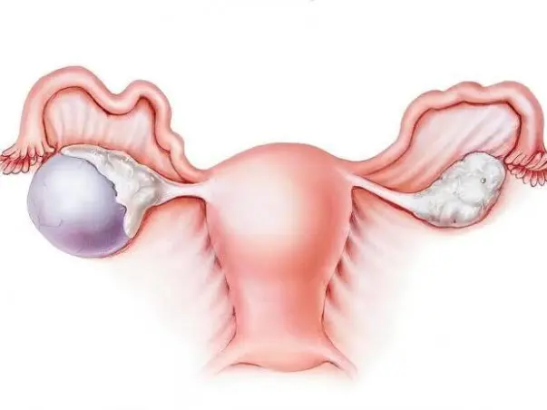 Help Revathi M For The Treatment Of Ovarian Mass
