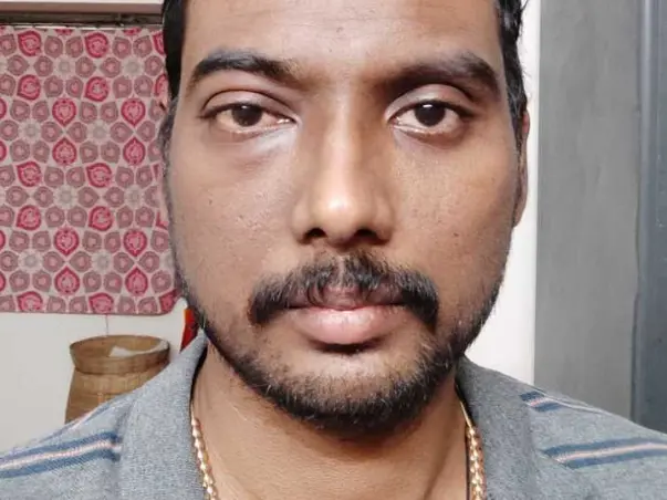 Arun needs to undergo surgery!Contribute generously&help beat cancer!