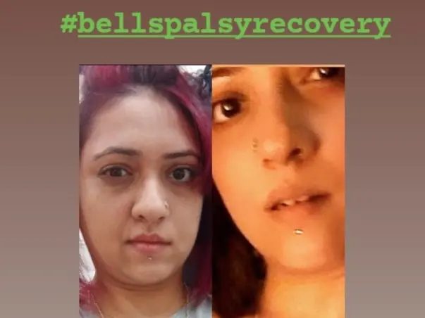 Faith's Bell's Palsy Journey