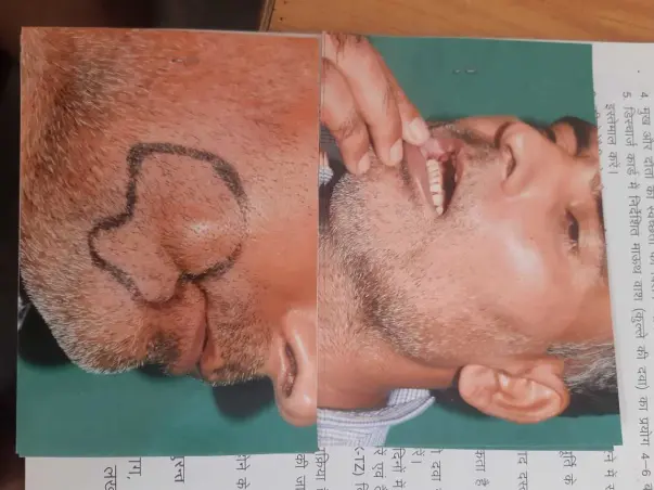 Support Anil Kumar Tiwari To Undergo From Mouth Cancer Surgery