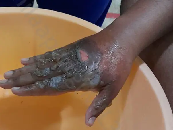 Save My Wife Recover From Thermal Burns