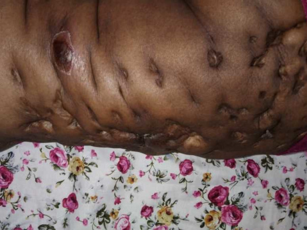 Help To Get Rid Of  Lymphedema And Cardiac Problem