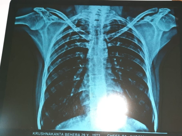 Help Krushna Chandra Behera Recover From Spinal Cord Injury