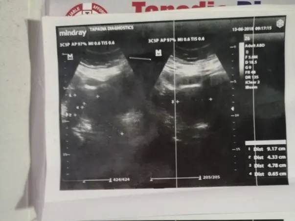 Support Vanaja Reddy recover from Bulky Uteru