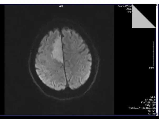 Need Your Help For My Father Brain Tumor Surgery