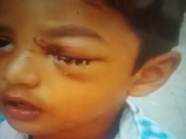 Support My Son To Undergo Eye Surgery
