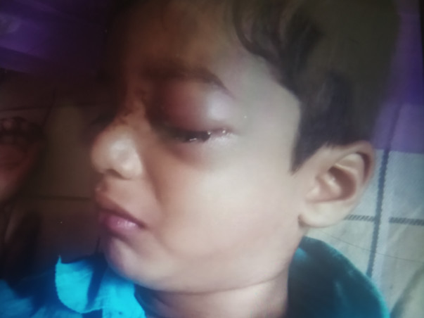 Support My Son To Undergo Eye Surgery