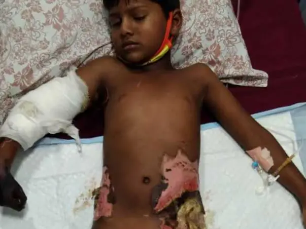 Sai Krishna Need Surgeries For Severe Burns