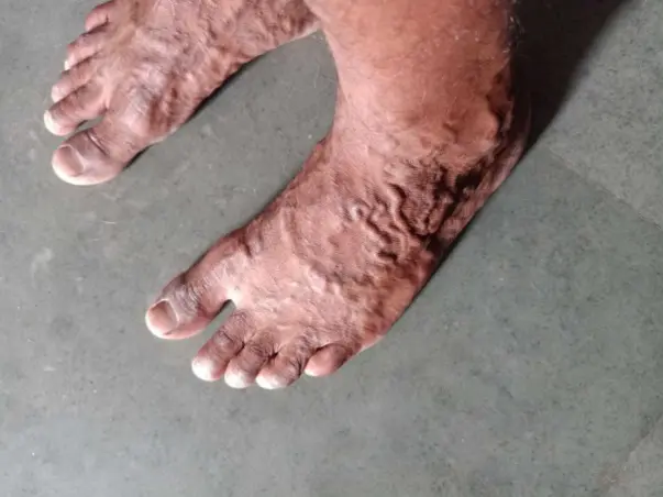 Help needed for 24 years old Medically complex Cook Sandeep Singh