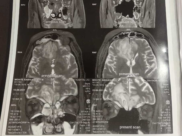 Help My Friend Abhijeet Mohite Recover From Mucormycosis (Black Fungus)