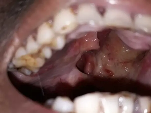 Help My Brother Swami's Fighting With Oral Cancer