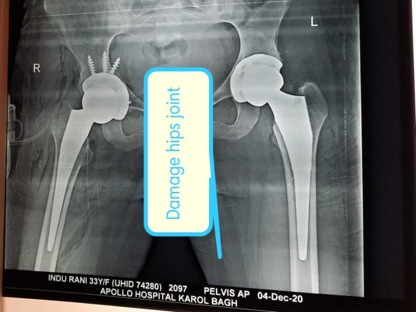 Support Indu Rani Recover From Hip Joint Disease