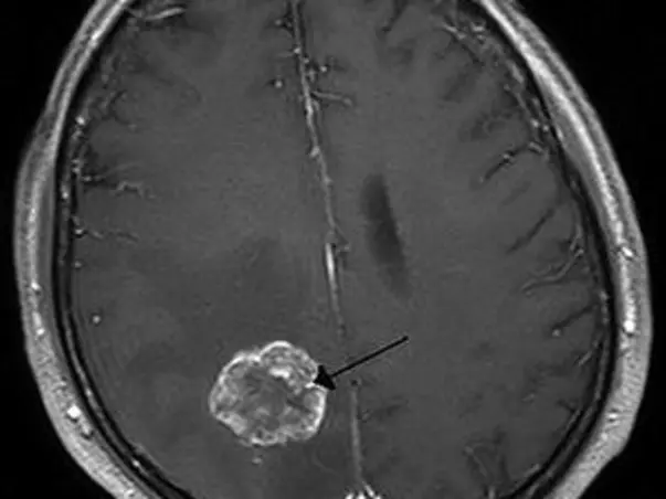 Help Me To Recover From Brain Tumor