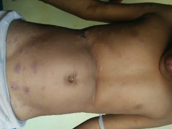 Help My Daughter Monika 7 yrs/O, Recover Skin Infection