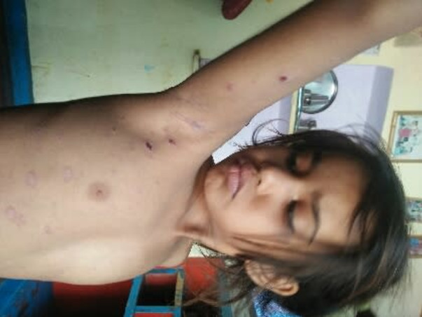 Help My Daughter Monika 7 yrs/O, Recover Skin Infection