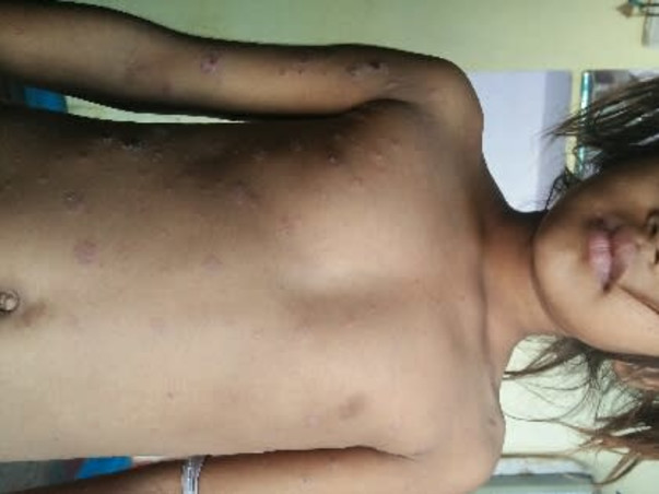 Help My Daughter Monika 7 yrs/O, Recover Skin Infection