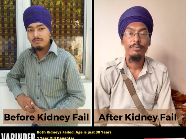 Save a Father of 1 Daughter. Both Kidneys Failed - Lets Donate Small