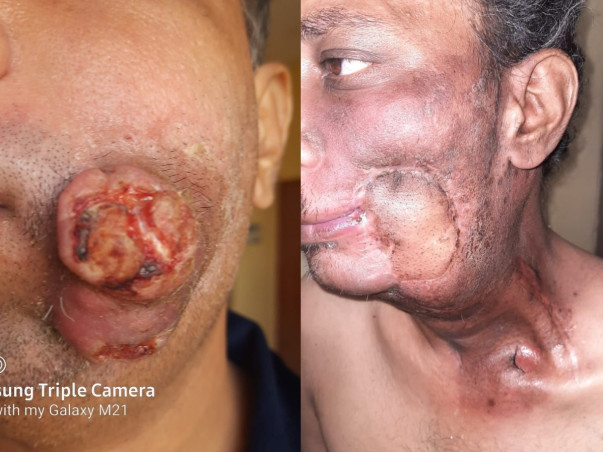 Help My Brother To Recover From Oral Cancer