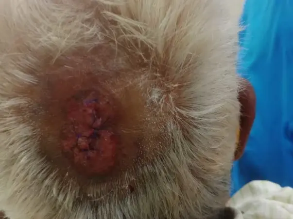Help My Relative Sriramulu Fight Multiple Brain Hemorrhage