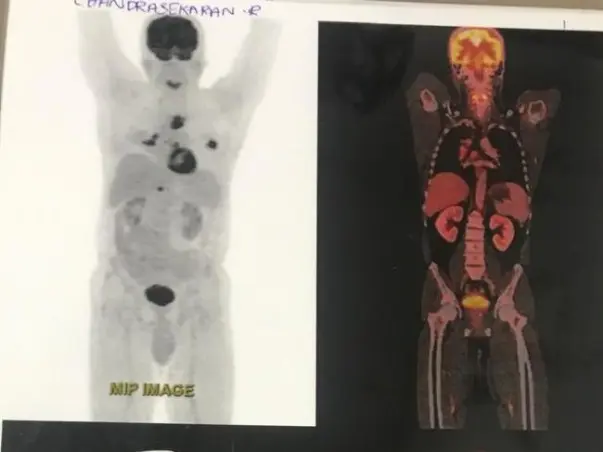 Help Chandrasekaran Recover Lung cancer