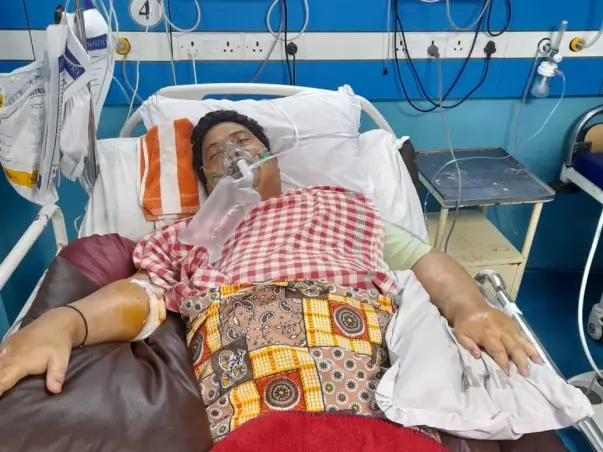 64 years old Sivadas Talukdar (Kidney Transplant patient) needs your help fight Post Covid Complications , currently on Ventilation support.