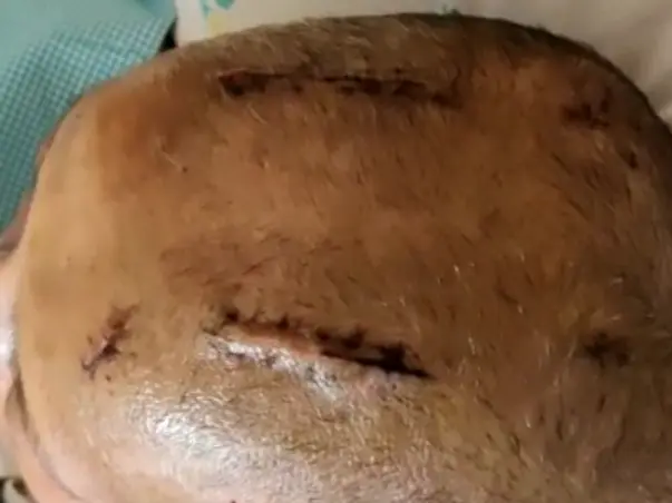Help My Mother Recover From Brain Hemorrhage