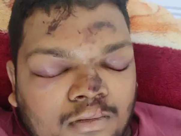 Please Support My Friend To Recover From Accidental Injuries (Skull  Bone Got Fractured)