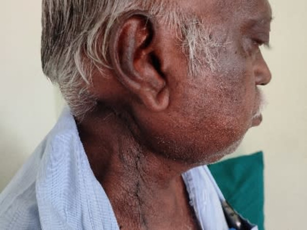 Support Radha Krishnan Recover From Skin Cancer