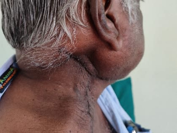 Support Radha Krishnan Recover From Skin Cancer