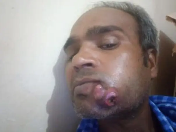 Support Md Basir To Recover From Oral Cancer
