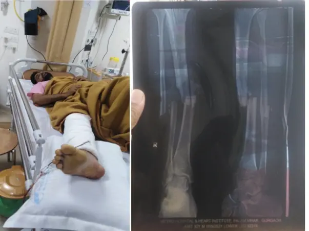 32 years old Amit Kumar Sharma needs your help fight Femur Shaft Fracture Treatment & Medicine