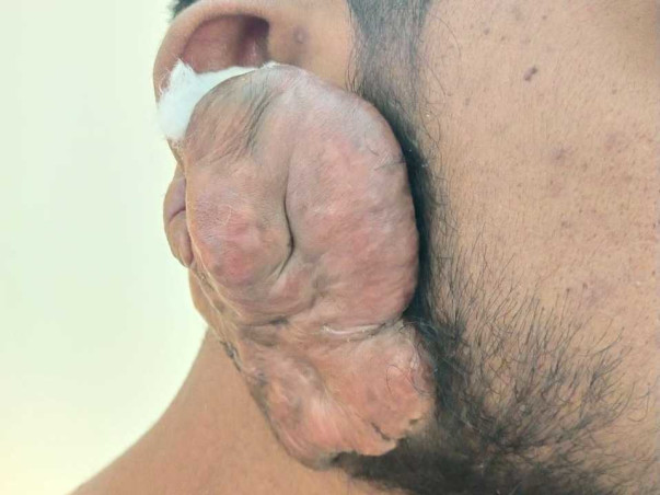 Support P S Udaya  To Recover From  KELOID