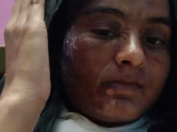 23 Years Old Nootan Needs Your Help To Recover From Deep Scald Ailment