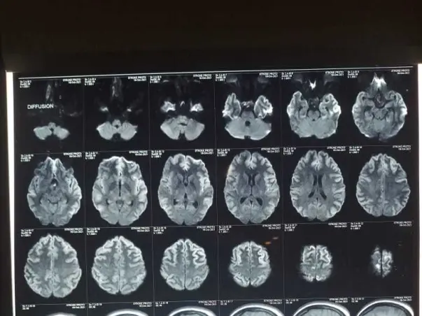Help My Sister Fight Brain Tumor and Hypoxy Brain Disease