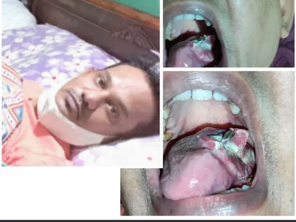 This 38 years old needs your urgent support in fighting with 3/4 area of Tongue Cancer.