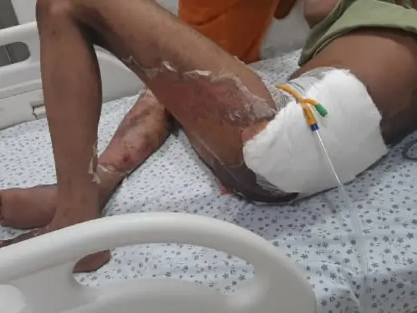 Help Thirupal nayak and Nagesh to recover from electrical burns