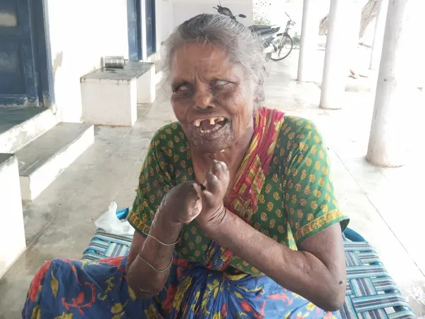 Help leprosy people's livelihood