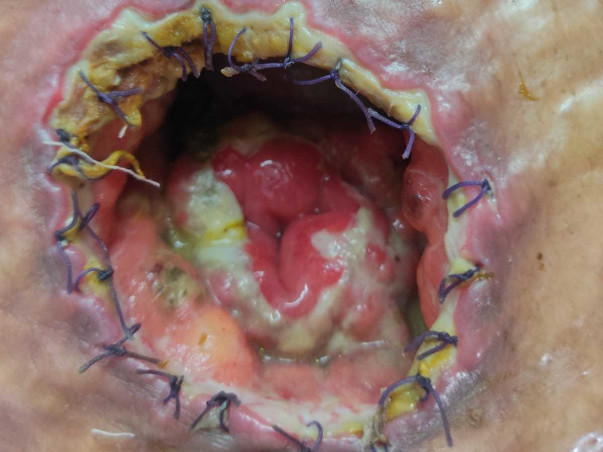 47 Years Old Kusum Kisku Needs Your Help Fight Lungs Infection & Gastroenteritis