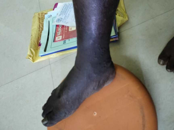 Please Support V Durga Prasad To Recover From Vascular Surgery