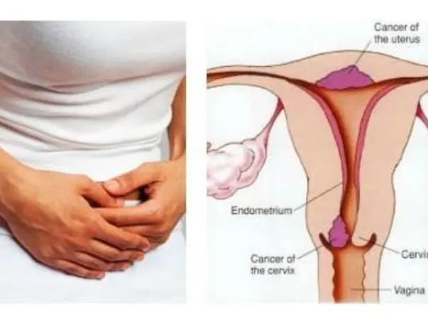 Support Manju Recover From Uterine cancer
