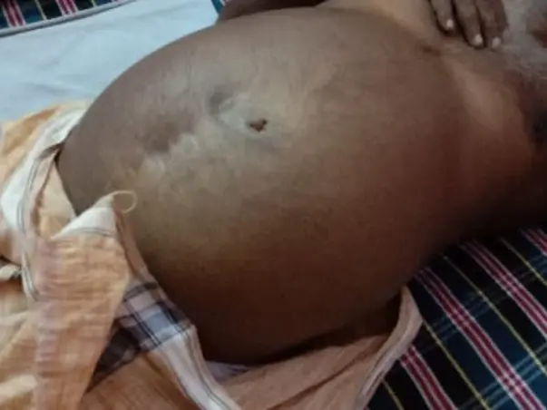Please help. My father is struggling with Liver cirrhosis and CKD
