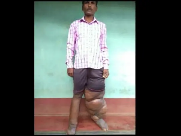 Support Tikru Babu Marati Recover From Lymphatic Filariasis