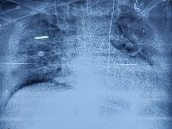 Support Rana Diwakar Singh To Recover From Lungs Infection