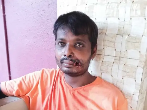 33 Years Old Dinesh Needs Your Help To Recover From Mouth Cancer