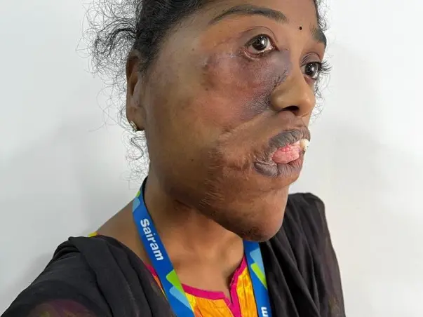 Support Komati Recover From Hemifacial Hypertrophy