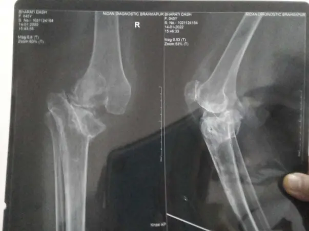 My Friend Bharati Dash Is Struggling With Knee Replacement Surgery,Her