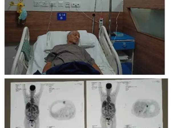 Please Help My Father To Fight Colon Cancer And Liver Metastasis