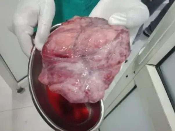 Help My Mother Suman To Recover Liver neoplasma tumor