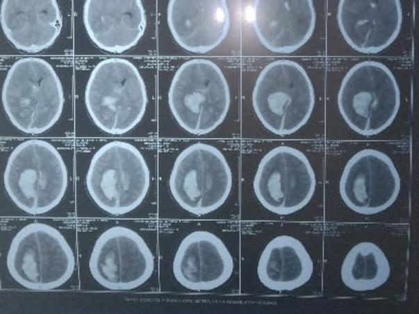 Help Ananda Mythreya Recover From CVA Right Capsule Ganglionic Bleed